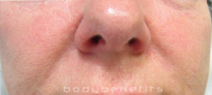 Mid Face Rejuvenation After at Body Benefits