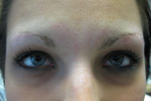 Brow Area before enhancement