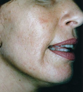Skin after 3 Medical Micro Needling Treatments