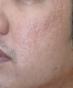 Acne Scarring after 3 Treatments