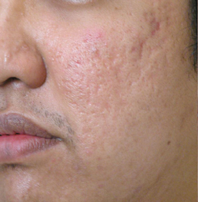 Acne Scarring before