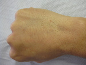 Right Fist After Dermal Filler