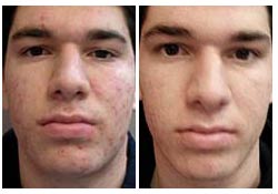 Before and After Isolaz Acne Treatments