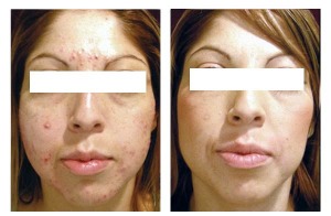 Before and After Isolaz Acne Treatments
