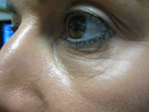 Before Body Benefits Upper Face Rejuvenation Programme