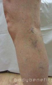 Veins on Left lower lateral leg before micro sclerotherapy treatment