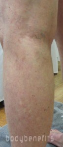 Left lower lateral leg one month post one micro sclerotherapy treatment at Body Benefits