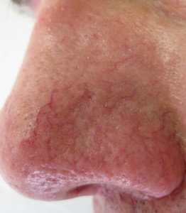 Nose during course of Treatments at Body Benefits