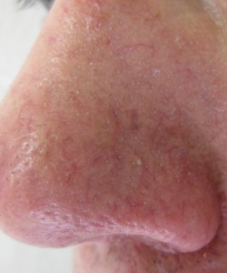 Nose after Laser Treatments at Body Benefits