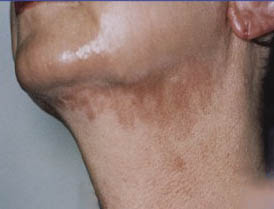 Pigmentation before treatment