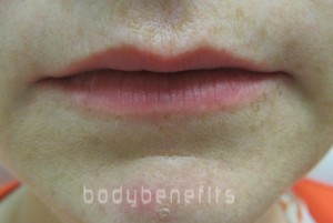 Before Lip Enhancement