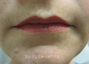 Lips after Permanent Cosmetic Enhancement