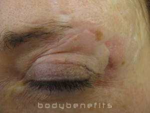 Eye Lid, Eyebrow and skin before Scar Treatment
