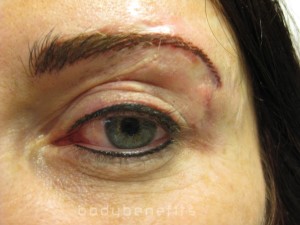 Eyelid and Eyebrow & Skin after Permanent Cosmetic Scar Camouflage