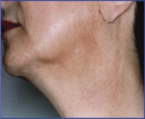 Neck Post Pigment Removal