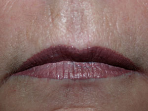 Lips after Permanent Cosmetic Colour