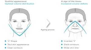 The V Effect available at Body Benefits