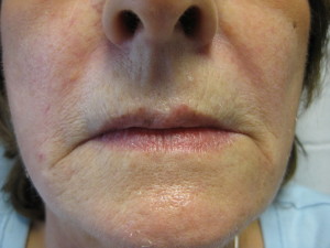 Lower Face after Filler