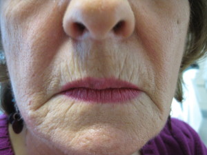 Lower Face before Filler at Body Benefits