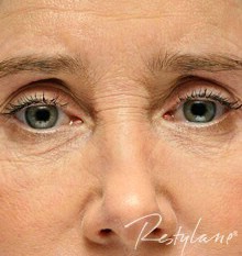 Eyes after Upper Face Enhancement with Dermal Filler