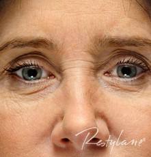Eyes before Upper Face Enhancement with Dermal Filler