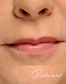 Smokers lines and lip support after filler