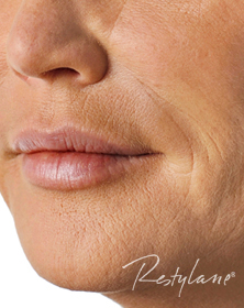 Lips, Smokers Lines and Smile Lines after Dermal Filler