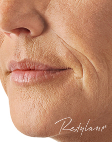 Lips, smokers lines and smile lines before Filler