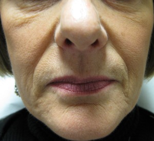 Face prior to commencing the Body Benefits Non-Surgical GALWAY Facelift