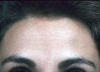 After Forehead Rejuvenation