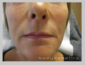 six months from commencement of Body Benefits Non-surgical GALWAY Facelift