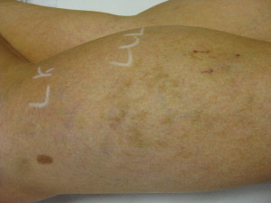 Leg Veins after 1st treatment at Body Benefits