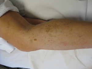 Leg Veins After One Treatment