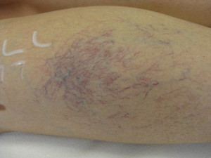 Leg Veins before treatment at Body Benefits