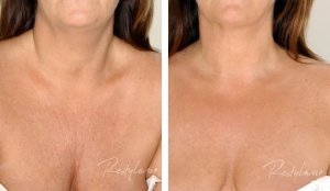 Decolletage Before & After with Restylane Skin Booster